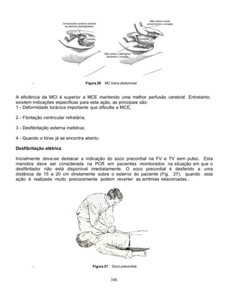 Figura 26   MC trans-abdominal



A eficiência da MCI é superior a MCE mantendo uma melhor perfusão cerebral. Entretanto,
existem indicações específicas para esta ação, as principais são:
1 - Deformidade torácica importante que dificulta a MCE;

2 - Fibrilação ventricular refratária;

3 - Desfibrilação externa inefetiva;

4 - Quando o tórax já se encontra aberto.

Desfibrilação elétrica

Inicialmente deve-se destacar a indicação do soco precordial na FV e TV sem pulso. Esta
manobra deve ser considerada na PCR em pacientes monitorados na situação em que o
desfibrilador não está disponível imediatamente. O soco precordial é desferido a uma
distância de 15 a 20 cm diretamente sobre o esterno do paciente (Fig. 27), quando esta
ação é realizada muito precocemente podem reverter as arritmias relacionadas..




                                             Figura 27   Soco precordial.


                                                         346
 