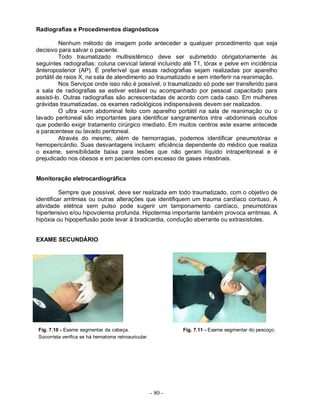 Radiografias e Procedimentos diagnósticos

          Nenhum método de imagem pode anteceder a qualquer procedimento que seja
decisivo para salvar o paciente.
          Todo traumatizado multisistêmico deve ser submetido obrigatoriamente às
seguintes radiografias: coluna cervical lateral incluindo até T1, tórax e pelve em incidência
ânteroposterior (AP). É preferível que essas radiografias sejam realizadas por aparelho
portátil de raios X, na sala de atendimento ao traumatizado e sem interferir na reanimação.
          Nos Serviços onde isso não é possível, o traumatizado só pode ser transferido para
a sala de radiografias se estiver estável ou acompanhado por pessoal capacitado para
assisti-lo. Outras radiografias são acrescentadas de acordo com cada caso. Em mulheres
grávidas traumatizadas, os exames radiológicos indispensáveis devem ser realizados.
          O ultra -som abdominal feito com aparelho portátil na sala de reanimação ou o
lavado peritoneal são importantes para identificar sangramentos intra -abdominais ocultos
que poderão exigir tratamento cirúrgico imediato. Em muitos centros este exame antecede
a paracentese ou lavado peritoneal.
          Através do mesmo, além de hemorragias, podemos identificar pneumotórax e
hemopericárdio. Suas desvantagens incluem: eficiência dependente do médico que realiza
o exame, sensibilidade baixa para lesões que não geram líquido intraperitoneal e é
prejudicado nos obesos e em pacientes com excesso de gases intestinais.


Monitoração eletrocardiográfica

          Sempre que possível, deve ser realizada em todo traumatizado, com o objetivo de
identificar arritmias ou outras alterações que identifiquem um trauma cardíaco contuso. A
atividade elétrica sem pulso pode sugerir um tamponamento cardíaco, pneumotórax
hipertensivo e/ou hipovolemia profunda. Hipotermia importante também provoca arritmias. A
hipóxia ou hipoperfusão pode levar à bradicardia, condução aberrante ou extrasístoles.


EXAME SECUNDÁRIO




Fig. 7.10 - Exame segmentar da cabeça.                        Fig. 7.11 - Exame segmentar do pescoço.
Socorrista verifica se há hematoma retroauricular.




                                                     - 80 -
 
