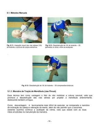 5.1. Métodos Manuais




Fig. 8.11 - Inspeção visual das vias aéreas (VA)   Fig. 8.12 - Desobstrução de VA de lactente – 05
de lactente, a procura de corpos estranhos.        palmadas no dorso, entre as escápulas



.




                    Fig. 8.13 - Desobstrução de VA de lactente – 05 compressões torácicas.


5.1.1. Manobra de Tração de Mandíbula (Jaw-Thrust)

Essa técnica tem como vantagem o fato de não mobilizar a coluna cervical, visto que
promove a desobstrução das vias aéreas por projetar a mandíbula anteriormente,
deslocando também a língua.

Como desvantagem, é tecnicamente mais difícil de executar, se comparada a manobra
de inclinação da cabeça e elevação do mento, além de não permitir que o socorrista
(estando sozinho) continue a avaliação da vítima, visto que estará com as duas
mãos envolvidas na manutenção da manobra.



                                                      - 98 -
 