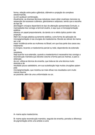 forma, relação entre pele e glândula, diâmetro e projeção do complexo
aréolo/mamila,
ou em qualquer combinação.
Atualmente, as diversas técnicas redutoras visam obter cicatrizes menores na
ressecção de excessos cutâneos, glandulares e adiposos, sendo que a escolha
do tipo de
abordagem cirúrgica dependerá do tipo de alteração apresentada.Contudo, a
mamoplastia traz consigo a temível cicatriz, é aqui que a micropigmentação
estética
oferece um papel preponderante, da dando cor e efeito óptico porém não
projeção.
Além da cirurgia plástica puramente estética, outra forma de aplicação da
micropigmentação é nas cirurgias de mastectomia. Devido ao câncer de mama
ser o de
maior incidência entre as mulheres no Brasil, em que boa parte dos casos seu
tratamento
é cirúrgico, levando a mastectomia parcial ou total, dependendo da extensão
da
neoplasia.
Seja qual for sua extensão, quando a mastectomia é necessária traz consigo a
reconstrução mamária que devolve volume e forma para as mamas, e para a
obtenção
da cor, utiliza-se técnica de enxertia, que trata-se de uma técnica muito
dolorida e de
resultado pouco satisfatório, em sua substituição hoje muitos cirurgiões optam
pela
micropigmentação, que mostrou-se mais eficaz nos resultados com muito
menos trauma
ao paciente, além de uma uniformidade na cor.




A- mama após mastectomia;

B- mama após reconstrução mamária, seguida de enxertia, perceba a diferença
de pigmentação entre uma aréola e outra
 