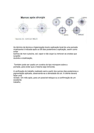 Ao término da técnica a higienização local e aplicação local de uma pomada 
cicatrizante é indicada após os 08 dias posteriores a aplicação, assim como 
evitar 
banhos de mar e piscina, sol, vapor e não coçar ou remover as crostas que 
surgirão 
durante a cicatrização, 
Também pode ser usado um curativo do tipo micropore sobre a 
pomada, para evitar que a mesma seja removida. 
A verificação do trabalho realizado será a partir dos quinze dias posteriores a 
pigmentação aplicada, observando-se a densidade da cor. A cliente deverá 
fazer uma 
revisão. Um mês após, para um possível retoque ou a confirmação de um 
excelente 
trabalho. 
 