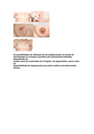 As possibilidades de utilização da micropigmentação no campo da 
dermatologia ou cirúrgica cosmética são praticamente ilimitadas, 
dependendo em 
muitos casos da criatividade do cirurgião e do pigmentador, assim como 
da 
disponibilidade do equipamento para poder realizar uma determinada 
técnica. 
 