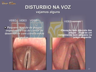 DISTURBIO NA VOZDISTURBIO NA VOZ
vejamos algunsvejamos alguns
•Elevação bem discreta das
pregas , nota-se um
rompimento bem pequeno na
prega esquerda
5151
Pequeno Nódulo de pregasPequeno Nódulo de pregas
impedindo a voz do cantor deimpedindo a voz do cantor de
desenvolver com clareza notasdesenvolver com clareza notas
agudasagudas
VIDEO VIDEO VIDEO VIDEO normais
 
