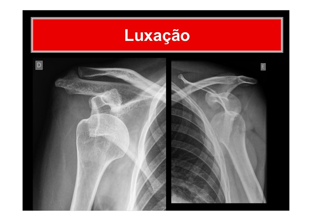 Apostila sobre a aula de incidências do ombro