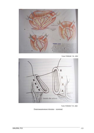 Fonte: FOSSUM, T.W., 2002
Fonte: FOSSUM, T.W., 2002
Enteroanastomose término – terminal.
_____________________________________________________________________________________
GALERA, P.D. 123
 
