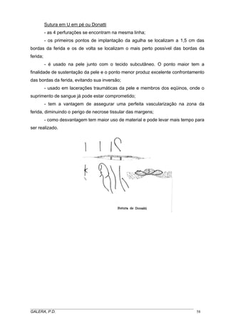 Sutura em U em pé ou Donatti
- as 4 perfurações se encontram na mesma linha;
- os primeiros pontos de implantação da agulha se localizam a 1,5 cm das
bordas da ferida e os de volta se localizam o mais perto possível das bordas da
ferida;
- é usado na pele junto com o tecido subcutâneo. O ponto maior tem a
finalidade de sustentação da pele e o ponto menor produz excelente confrontamento
das bordas da ferida, evitando sua inversão;
- usado em lacerações traumáticas da pele e membros dos eqüinos, onde o
suprimento de sangue já pode estar comprometido;
- tem a vantagem de assegurar uma perfeita vascularização na zona da
ferida, diminuindo o perigo de necrose tissular das margens;
- como desvantagem tem maior uso de material e pode levar mais tempo para
ser realizado.
_____________________________________________________________________________________
GALERA, P.D. 58
 