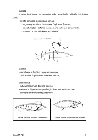Cushing
- sutura invaginante, seromuscular, não contaminada, utilizada em órgãos
ocos;
- inverte a mucosa e aproxima a serosa;
- segundo ponto de fechamento de órgãos em 2 planos;
- as perfurações são feitas paralelamente às bordas do ferimento;
- a sutura cruza a incisão em ângulo reto.
Connell
- semelhante a Cushing, mas é seromucosa;
- utilizada em órgãos ocos, inverte os tecidos.
Intradérmica
- sutura intradérmica de efeito estético;
- seqüência de pontos simples longitudinais nas bordas da pele;
- excelente confrontamento anatômico.
_____________________________________________________________________________________
GALERA, P.D. 65
 