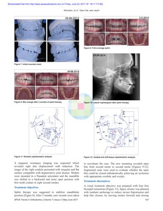 Weinstein, et al.: Open bite case report
APOS Trends in Orthodontics | Volume 7 | Issue 3 | May-June 2017 147
A magnetic resonance imaging was requested which
revealed right disc displacement with reduction. The
image of the right condyle presented with irregular and flat
surface compatible with degenerative joint disease. Models
were mounted in a Panadent articulator and the mandible
was shifted to a backward and more open position with
first tooth contact in right second molars.
Treatment objectives
Splint therapy was suggested to stabilize mandibular
position [Figure 8]. After 5 months, new records were taken
to reevaluate the case. The new mounting revealed open
bite from second molar to second molar [Figures 9-12].
Segmented casts were used to evaluate whether the open
bite could be closed orthodontically achieving an occlusion
with appropriate overbite and overjet.
Treatment alternatives
A visual treatment objective was prepared with four first
bicuspid extractions [Figure 13]. Space closure was planned
with medium anchorage to reduce incisor biprotrusion and
help bite closure, by moving molars forward and closing
Figure 7: Initial mounted casts
Figure 8: Full‑coverage splint
Figure 9: Bite change after 3 months of splint therapy Figure 10: Lateral cephalogram after splint therapy
Figure 11: Ricketts cephalometric analysis Figure 12: Jarabak and soft‑tissue cephalometric analysis
[Downloaded free from http://www.apospublications.com on Friday, June 23, 2017, IP: 191.7.177.80]
 