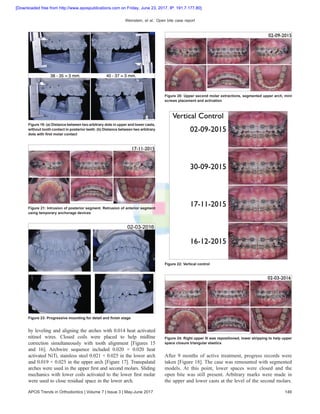 Weinstein, et al.: Open bite case report
APOS Trends in Orthodontics | Volume 7 | Issue 3 | May-June 2017 149
by leveling and aligning the arches with 0.014 heat activated
nitinol wires. Closed coils were placed to help midline
correction simultaneously with tooth alignment [Figures 15
and 16]. Archwire sequence included 0.020  ×  0.020 heat
activated NiTi, stainless steel 0.021 × 0.025 in the lower arch
and 0.019 × 0.025 in the upper arch [Figure 17]. Transpalatal
arches were used in the upper first and second molars. Sliding
mechanics with lower coils activated to the lower first molar
were used to close residual space in the lower arch.
After 9 months of active treatment, progress records were
taken [Figure 18]. The case was remounted with segmented
models. At this point, lower spaces were closed and the
open bite was still present. Arbitrary marks were made in
the upper and lower casts at the level of the second molars.
Figure 19: (a) Distance between two arbitrary dots in upper and lower casts,
without tooth contact in posterior teeth. (b) Distance between two arbitrary
dots with first molar contact
Figure 20: Upper second molar extractions, segmented upper arch, mini
screws placement and activation
Figure 21: Intrusion of posterior segment. Retrusion of anterior segment
using temporary anchorage devices
Figure 22: Vertical control
Figure 23: Progressive mounting for detail and finish stage
Figure 24: Right upper 5I was repositioned, lower stripping to help upper
space closure triangular elastics
[Downloaded free from http://www.apospublications.com on Friday, June 23, 2017, IP: 191.7.177.80]
 