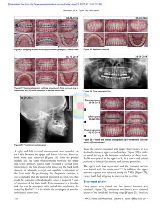 Weinstein, et al.: Open bite case report
150 APOS Trends in Orthodontics | Volume 7 | Issue 3 | May-June 2017
A right and left vertical measurement was recorded on
each side between the upper and lower reference. Posterior
teeth were then removed [Figure 19] from the pinned
models and the same measurements between the upper
and lower arbitrary marks were recorded a second time.
Interestingly, the bite closed after removing the back teeth
showed an adequate overjet and overbite relationship of
the front teeth. By performing this diagnostic exercise, it
was concluded that the patient presented an open bite that
could be corrected orthodontically, since it required 3 mm
of intrusion of the back teeth. This movement is a feasible
task that can be attempted with orthodontic mechanics. As
stated by Proffit,[12,13]
it is within the envelopes of possible
orthodontic correction.
Since the patient presented with upper third molars, it was
decided to remove upper second molars [Figure 20] in order
to avoid having to do intrusion mechanics of these teeth.
TADs were placed in the upper arch, in a buccal and palatal
position, to intrude first molars and second premolars.
The upper arch was segmented and the posterior section
was loaded with the miniscrews.[14]
In addition, the upper
anterior segment was retracted using the TADs [Figure 21].
Lower teeth had stripping to improve the overbite.
Treatment results
Once spaces were closed and the desired intrusion was
obtained [Figure 22]; continuous mechanics were resumed
as part of the detail and finishing stage [Figure 23]. Brackets
Figure 25: Stripping of lower incisors to close black triangles. Lower c‑chain Figure 26: Appliance removal
Figure 27: Retainer placement with rap around arch. Note occlusal stop in
mandibular arch to avoid extrusion in second molar area Figure 28: Final panoramic film
Figure 29: Final lateral cephalogram
Figure 30: Frontal and overjet photographs (a) Pretreatment. (b) After
splint. (c) Posttreatment
c
b
a
[Downloaded free from http://www.apospublications.com on Friday, June 23, 2017, IP: 191.7.177.80]
 