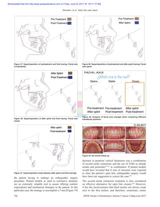 Weinstein, et al.: Open bite case report
152 APOS Trends in Orthodontics | Volume 7 | Issue 3 | May-June 2017
the patient having to undergo an orthognathic surgery
procedure. Pinned models as used in restorative dentistry
are an extremely valuable tool to assure offering realistic
expectations and mechanical strategies to the patient. In this
particular case, the strategy to accomplish a 3 mm [Figure 19]
decrease in posterior vertical dimension was a combination
of second molar extractions and the use of TADs to intrude
molars and premolars[15,16]
in combination. If pinned models
would have revealed that 8  mm of intrusion were required
to close the patient’s open bite, orthognathic surgery would
have been our suggestion to correct the case.[17]
The second molar extraction treatment is also considered
an effective alternative for open bite closure.[18]
However,
it has the inconvenience that third molars not always erupt
next to the first molars, and therefore, sometimes, minor
Figure 38: Superimposition of pretreatment and after splint tracing: Facial
axis opens
Figure 37: Superimposition of pretreatment and final tracing: Facial axis
is maintained
Figure 39: Superimposition of after splint and final tracing: Facial axis
closes
Figure 40: Analysis of facial axis changes when comparing different
mandibular positions
Figure 41: Superimposition areas between after splint and final tracings
Figure 42: Six‑month follow‑up
[Downloaded free from http://www.apospublications.com on Friday, June 23, 2017, IP: 191.7.177.80]
 