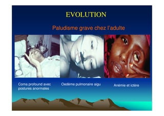 Oedème pulmonaire aiguComa profound avec
postures anormales
Anémie et ictère
EVOLUTION
Paludisme grave chez l’adulte
 