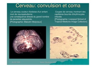06/05/200806/05/2008 Atelier Paludisme 2008Atelier Paludisme 2008
Cerveau: convulsion et comaCerveau: convulsion et coma
Le cerveau couleur d'ardoise d'un enfant
mort de neuropaludisme;
une conséquence directe du grand nombre
de parasites séquestrés.
[Photographie: Malcolm Molyneux]
Coupes de cerveau montrant des
capillaires bourrés d'érythrocytes
infectés
[Photographie: Liverpool School of
Tropical Medicine Image Collection]
 