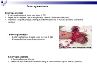 Emorragie esterne
Emorragia arteriosa
• il colore del sangue è rosso vivo (ricco di O2)
• la perdita di sangue è rapida e copiosa (in rapporto al diametro del vaso)
• di solito il sangue fuoriesce a fiotti pulsando ritmicamente in maniera sincrona con i battiti
cardiaci
Emorragia venosa
• il colore del sangue è rosso scuro (povero di O2)
• il sangue fuoriesce con flusso costante
Emorragia capillare
• il flusso del sangue è lento
• la ferita è descritta come trasudante sangue spesso misto a liquido sieroso (plasma)
LACERAZIONE DELL’ARTERIA RADIALE
 