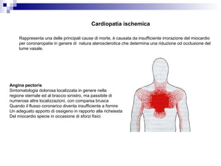 Cardiopatia ischemica
Rappresenta una delle principali cause di morte, è causata da insufficiente irrorazione del miocardio
per coronaropatie in genere di natura aterosclerotica che determina una riduzione od occlusione del
lume vasale.
Angina pectoris
Sintomatologia dolorosa localizzata in genere nella
regione sternale ed al braccio sinistro, ma passibile di
numerose altre localizzazioni, con comparsa brusca
Quando il flusso coronarico diventa insufficiente a fornire
Un adeguato apporto di ossigeno in rapporto alla richeiesta
Del miocardio specie in occasione di sforzi fisici.
 