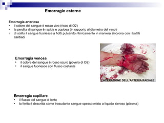 Emorragie esterne
Emorragia arteriosa
• il colore del sangue è rosso vivo (ricco di O2)
• la perdita di sangue è rapida e copiosa (in rapporto al diametro del vaso)
• di solito il sangue fuoriesce a fiotti pulsando ritmicamente in maniera sincrona con i battiti
cardiaci
Emorragia venosa
• il colore del sangue è rosso scuro (povero di O2)
• il sangue fuoriesce con flusso costante
Emorragia capillare
• il flusso del sangue è lento
• la ferita è descritta come trasudante sangue spesso misto a liquido sieroso (plasma)
LACERAZIONE DELL’ARTERIA RADIALE
 