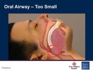 Oral Airway – Too Small

Pediatrics

Page 12
xxx00.#####.ppt 11/14/13 09:29 PM

 