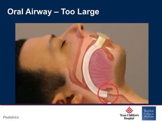 Oral Airway – Too Large

Pediatrics

Page 13
xxx00.#####.ppt 11/14/13 09:29 PM

 