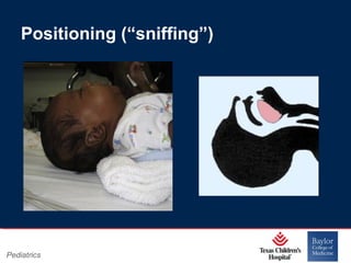 Positioning (“sniffing”)

Pediatrics

Page 3
xxx00.#####.ppt 11/14/13 09:29 PM

 