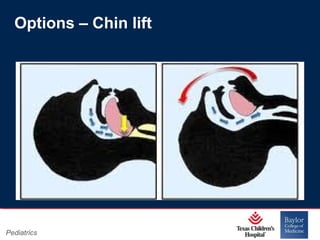 Options – Chin lift

Pediatrics

Page 7
xxx00.#####.ppt 11/14/13 09:29 PM

 