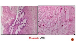 APPENDICEAL MUCINOUS LESIONS oncology.pptx