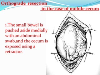 Orthograde resection
                  in the case of mobile cecum


 1.The small bowel is
 pushed aside medially
 with an abdominal
 swab,and the cecum is
 exposed using a
 retractor.
 