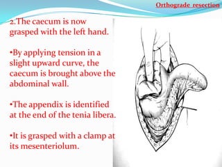 Orthograde resection

2.The caecum is now
grasped with the left hand.

•By applying tension in a
slight upward curve, the
caecum is brought above the
abdominal wall.

•The appendix is identified
at the end of the tenia libera.

•It is grasped with a clamp at
its mesenteriolum.
 