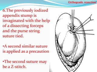 Orthograde resection


6.The previously iodized
appendix stump is
invaginated with the help
of a dissecting forceps
and the purse string
suture tied.

•A second similar suture
is applied as a precaution

•The second suture may
be a Z-stitch.
 