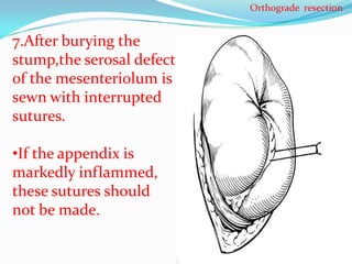 Orthograde resection


7.After burying the
stump,the serosal defect
of the mesenteriolum is
sewn with interrupted
sutures.

•If the appendix is
markedly inflammed,
these sutures should
not be made.
 