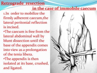 Retrograde resection
              in the case of immobile caecum
 1.In order to mobilize the
 firmly adherent caecum,the
 lateral peritonial reflection
 is incised.
 •The caecum is free from the
 lateral abdominal wall by
 blunt dissection until the
 base of the appendix comes
 into view as a prolongation
 of the tenia libera.
 •The appendix is then
 isolated at its base, crushed,
 and ligated.
 