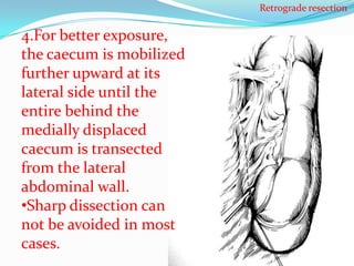 Retrograde resection

4.For better exposure,
the caecum is mobilized
further upward at its
lateral side until the
entire behind the
medially displaced
caecum is transected
from the lateral
abdominal wall.
•Sharp dissection can
not be avoided in most
cases.
 