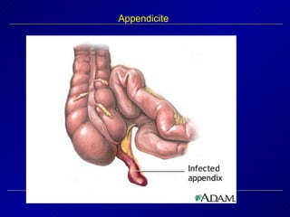 Appendicite 