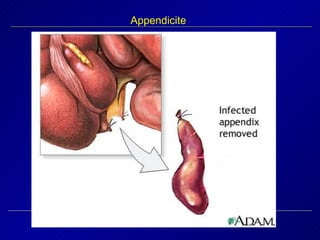 Appendicite 