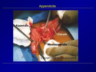Appendicite 