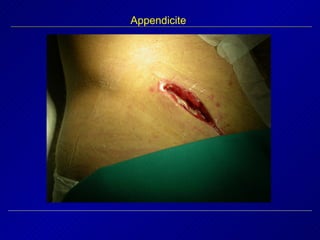 Appendicite 
