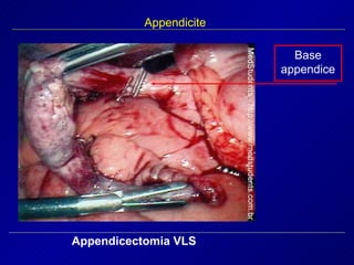 Appendicite Appendicectomia VLS Base appendice 