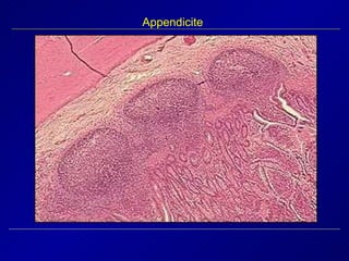 Appendicite 