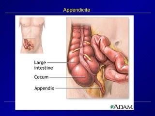 Appendicite 