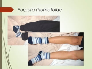Purpura rhumatoïde
 