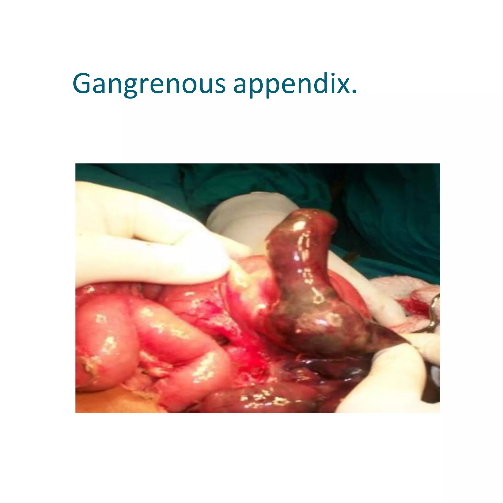 Gangrenous appendix.
 