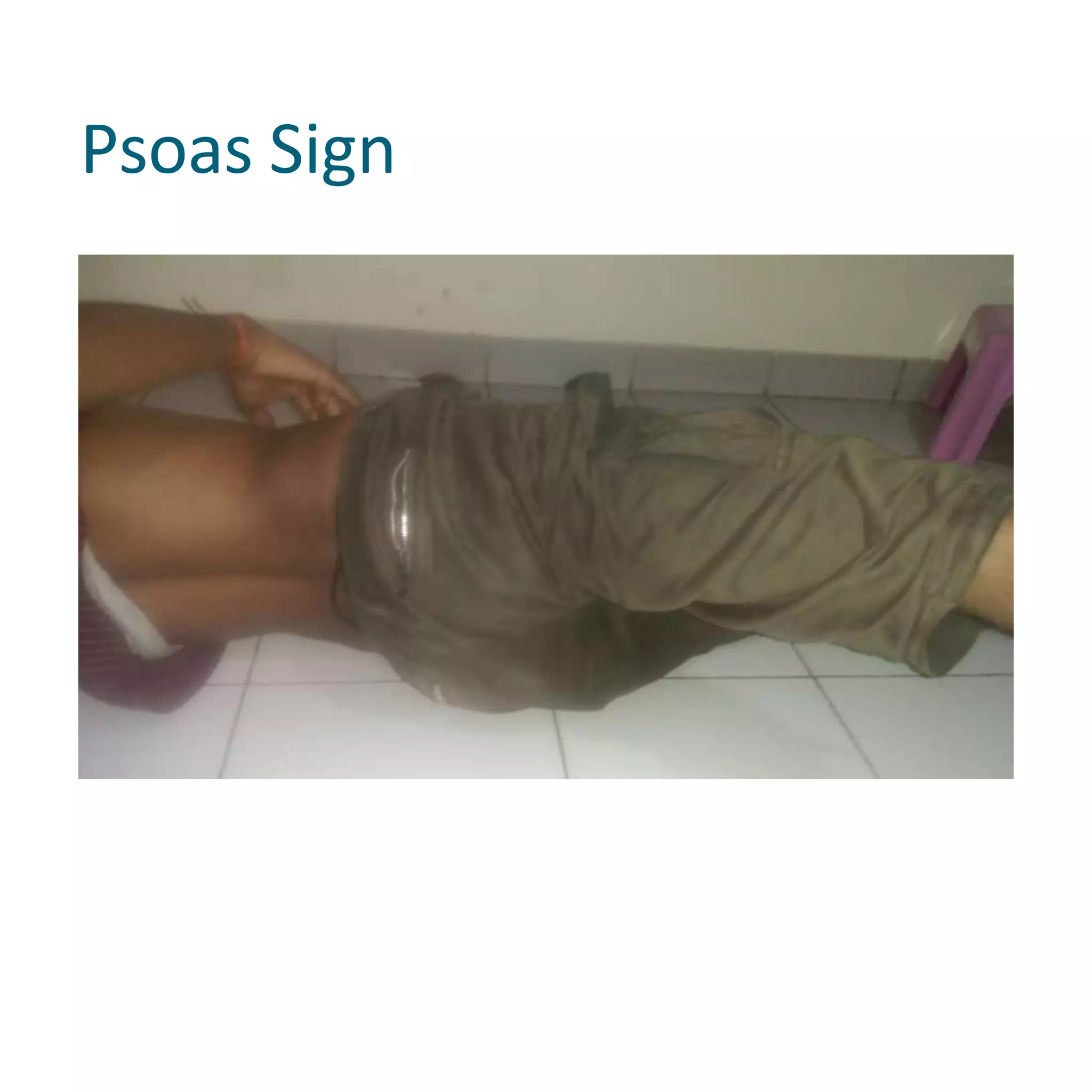 Psoas Sign
 