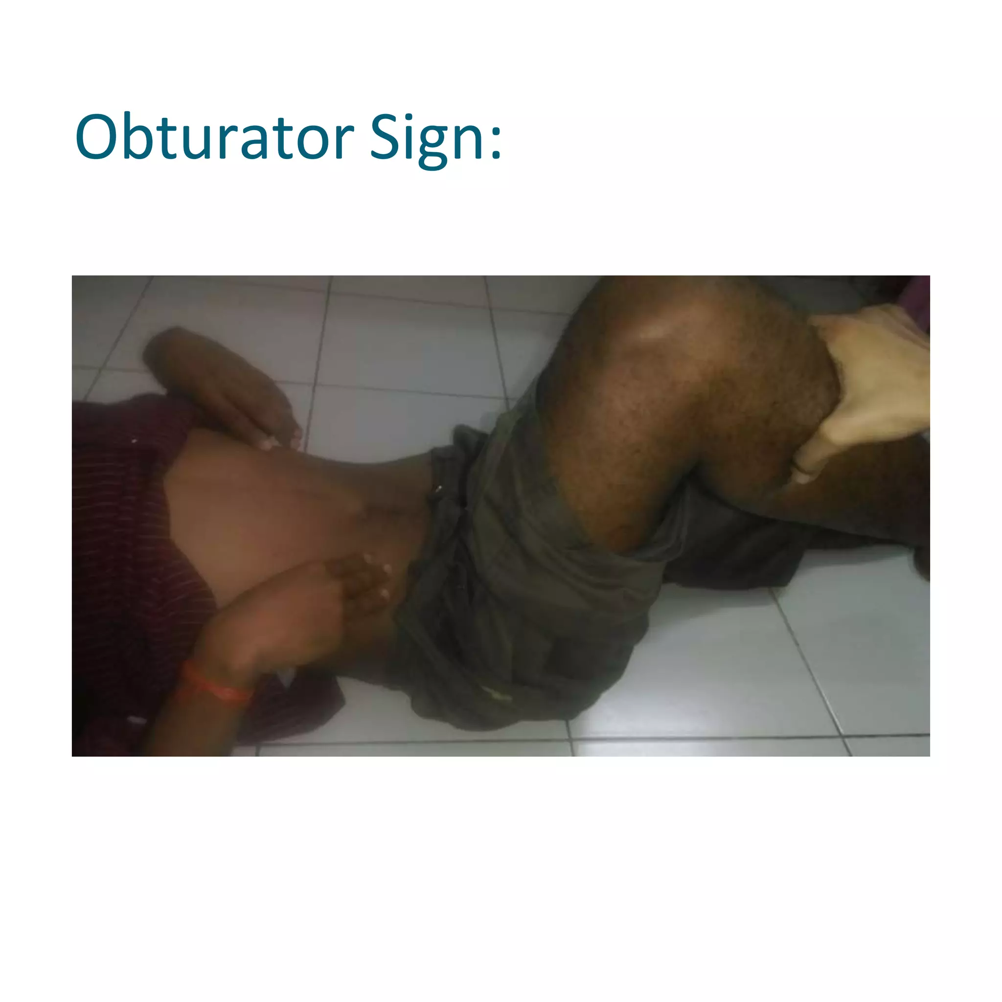 Obturator Sign:
 