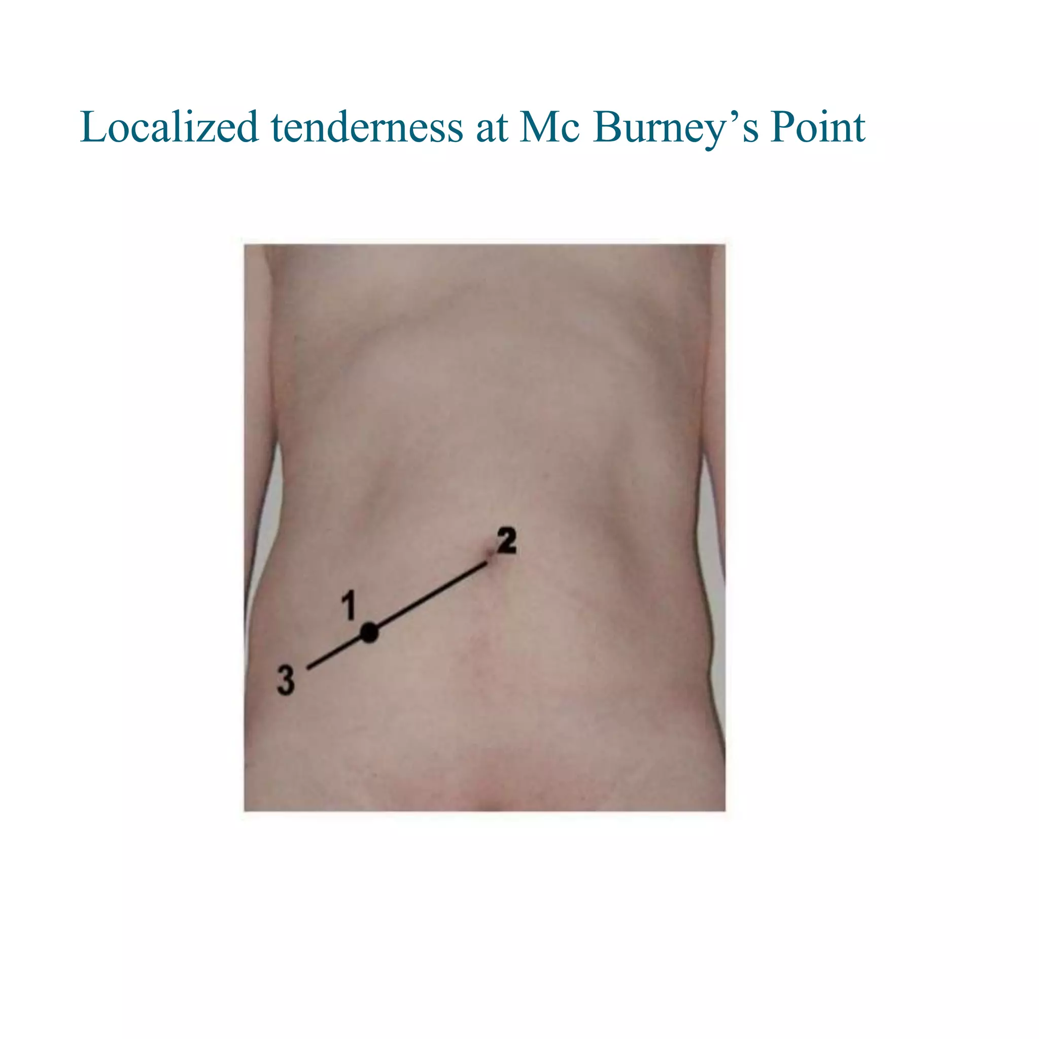 Localized tenderness at Mc Burney’s Point
 