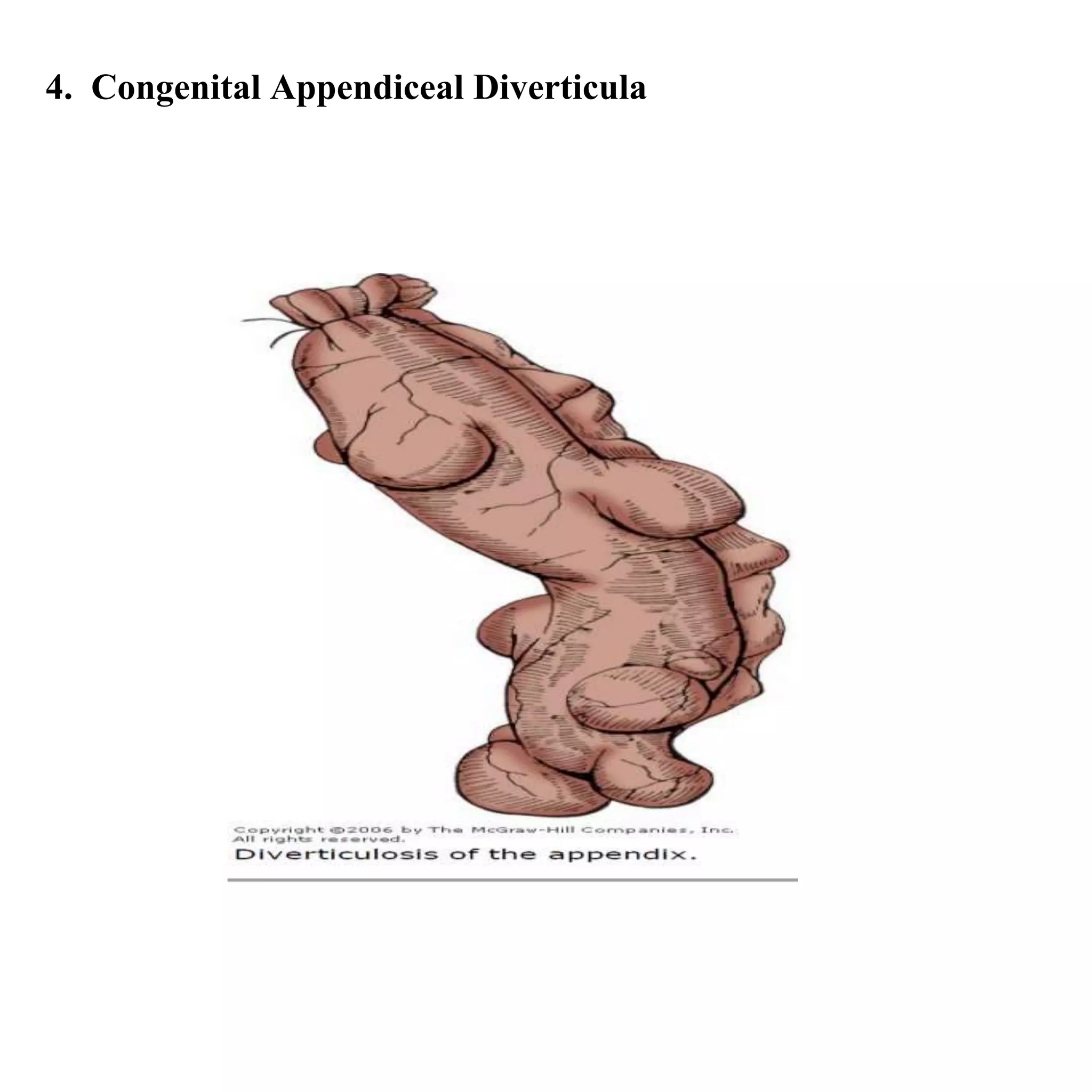 4. Congenital Appendiceal Diverticula
 