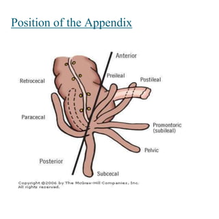 Appendicitis | PPTX