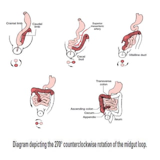Appendix Loop Appendicitis | PPTX