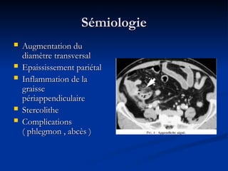 Sémiologie
Sémiologie
 Augmentation du
Augmentation du
diamètre transversal
diamètre transversal
 Epaississement pariétal
Epaississement pariétal
 Inflammation de la
Inflammation de la
graisse
graisse
périappendiculaire
périappendiculaire
 Stercolithe
Stercolithe
 Complications
Complications
( phlegmon , abcès )
( phlegmon , abcès )
 