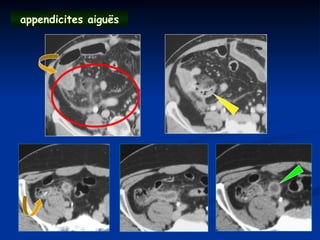 appendicites aiguës
 