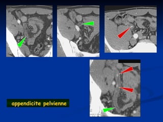 appendicite pelvienne
 