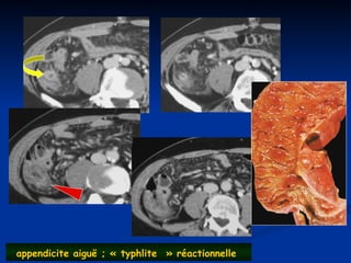 appendicite aiguë ; « typhlite » réactionnelle
 